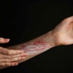 Behandlung von verbrennungen auf weibliche hand auf schwarzem hintergrund