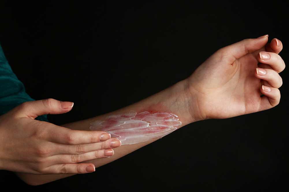 Behandlung von verbrennungen auf weibliche hand auf schwarzem hintergrund