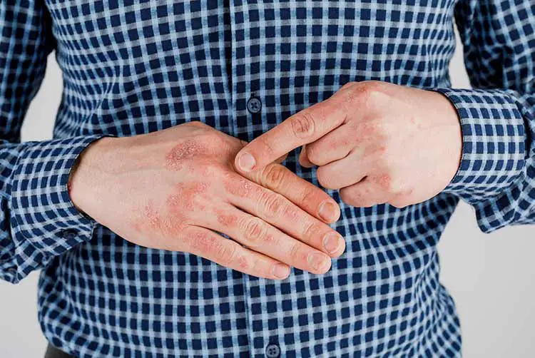 Mann mit kranken händen, trockener, schuppiger haut an der hand mit vulgärer psoriasis, ekzemen und anderen hautkrankheiten wie pilzen, plaque, hautausschlag und hautunreinheiten. genetische autoimmunerkrankung.